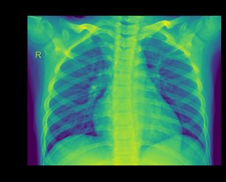 &ldquo;Chest x-ray image of normal lungs&rdquo;